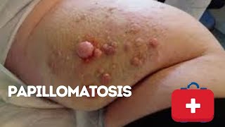 Papillomatosis, Atrophy And Alterationsof The Granular Layer