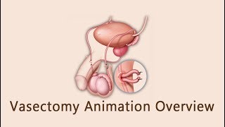 Vasectomy Animation Overview