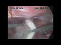 hernioplastia