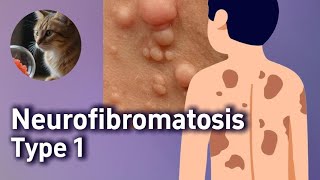 What Is Neurofibromatosis Type 1, Neurofibroma, Café-Au-Lait Spot, Lisch Nodule, Optic Glioma, Usmle