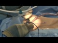 Breast Augmentation using saline filled breast implants