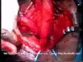 Penectomy