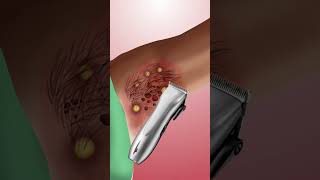 Remove Armpit Hair & Tick From Infected Armpit