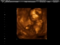 Melissa and Jason's Baby Girl - 17 week fetal 3D 4D Ultrasound