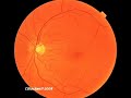 Retina