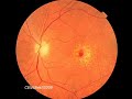 Retina