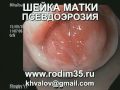 Эрозия шейки матки. Цервикоскопия и гистероскопия