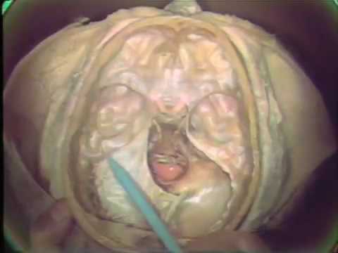 Gross Anatomy: Cranial Meninges, Dural Venous Sinuses and Cerebrospinal