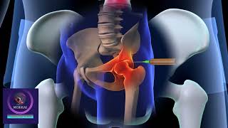 Hip Joint Pain Non Surgical Solution, Injection Treatment