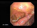 Worm in Small Intestine