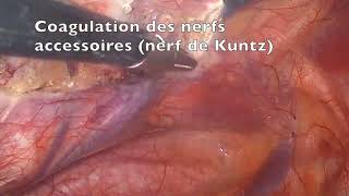 Sympathectomie thoracique (décubitus ventral) - Dr Thibaut COSTE