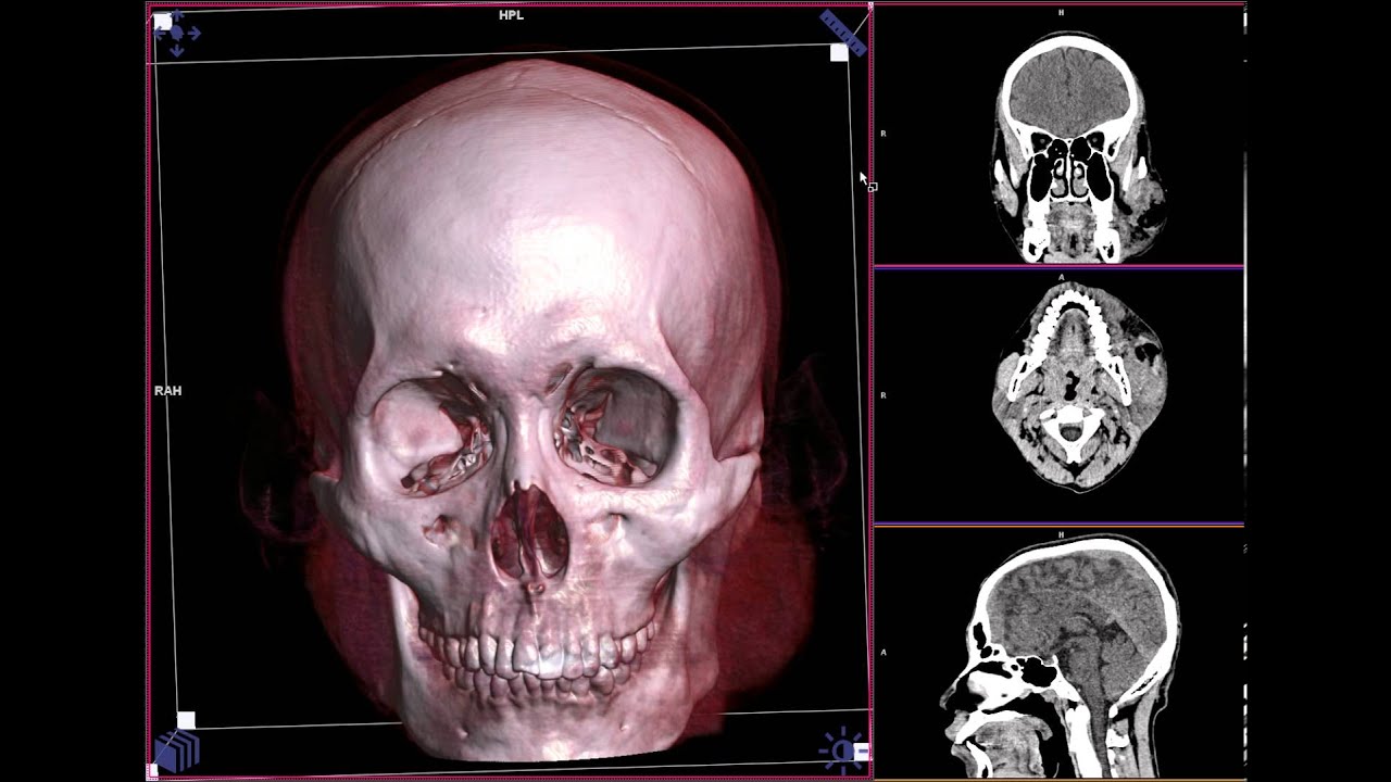 HEAD CT SCAN BONE FACE - YouTube