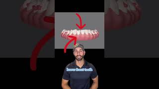 How I Plan To Fix This Patients Deep Bite With Invisalign.