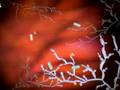 Yeast Infection Symptoms What is a Yeast Infection? default