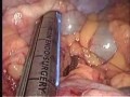 Laparoscopic Assisted Ileocolic Resection for Crohn&#039;s Disease with Psoas Abscess