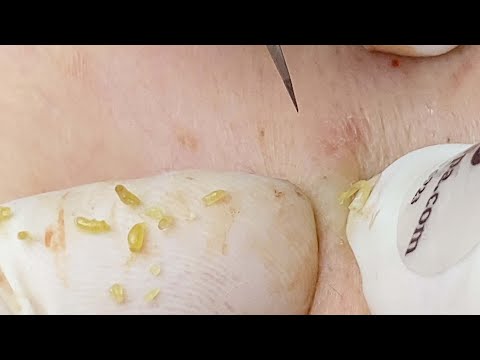 Acne Hidden Too Deep Under The Skin | Mụn Chân Sâu Dưới Da Và Cái Kết Bất Ngờ - SacDepSpa#191