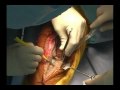 Incision and Exposure - Total Knee Revision
