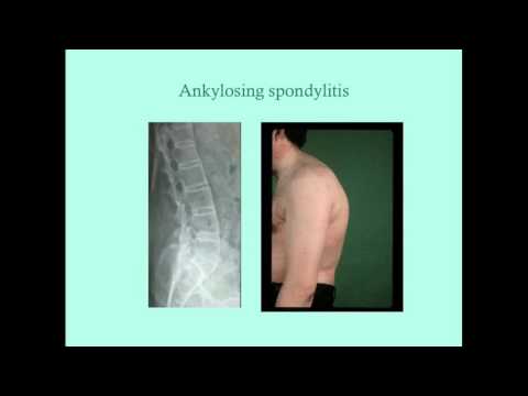 Rheumatology Review Questions - CRASH! Medical Review Series