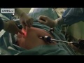 gynecological surgery removal of the uterus