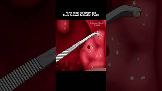 Asmr Tonsil Treatment And Stone Removal Animation Bad Breath Part 3