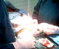 Cauterization,Electrocautery