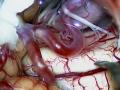 PICA-PICA bypass for trapping of giant aneurysm