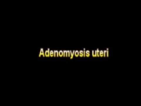 Header of Adenomyosis
