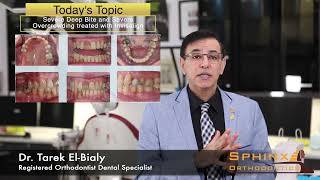 - Case Study - Severe Deep Bite And Severe Overcrowding Treated With Invisalign