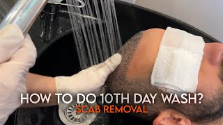 How To Do 10Th Day Scab Removal Wash After Hair Transplantation I I Murat Makascı Clinic