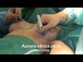 Inverted nipple correction & breast implant