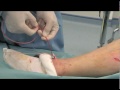 safenectomia