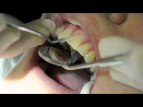 diy dental bonding teeth bonding teeth bonding procedure how to save diy dental bonding teeth bonding teeth bonding procedure how to save