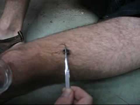 Photos+of+Cow+Ant+Bites Ant sting, Myrmecology, Parasitic infestations, stings, and bites of ...