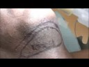 The Submental Island Flap
