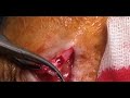 safenectomia