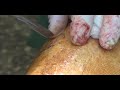 safenectomia