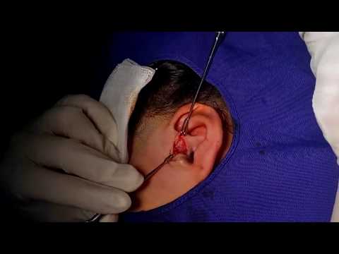 RÒ LUÂN NHĨ// CA KHÓ// ĐƯỜNG RÕ CỬA ỐNG TAI NGOÀI// Q BY BS NAM TMH ÂN THI HƯNG YÊN 0965861800