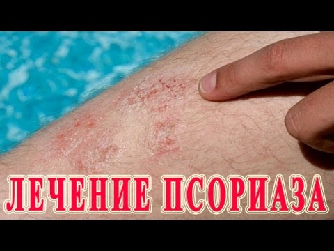 Как в домашних условиях вылечить псориаз на голове Как в домашних условиях вылечить псориаз на