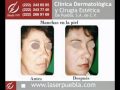 Clínica Dermatológica y Cirugía Estética de Puebla® - Tratamientos Láser para Acné y Manchas