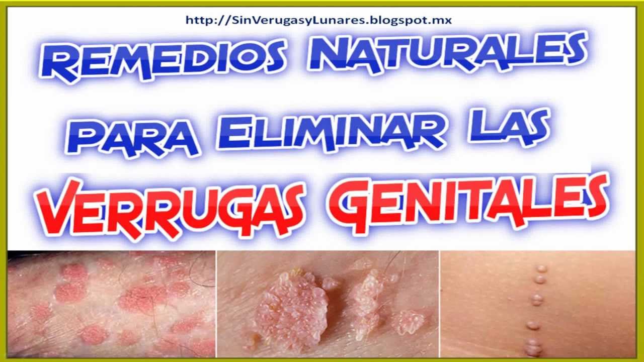 Como son las verrugas del vph fotos 10 Como son las verrugas del vph fotos 62