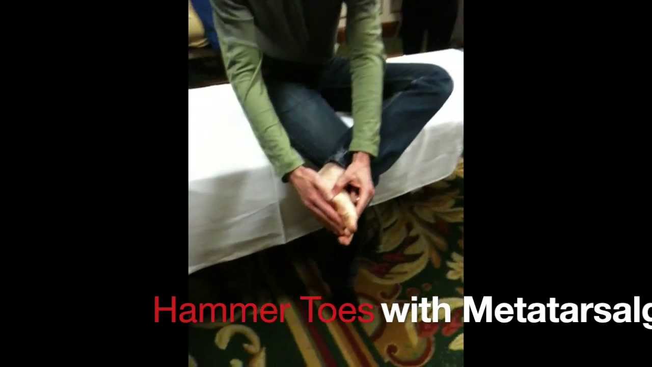 Hammertoe