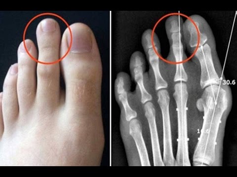 Only 14% of World Population Has Longer Second Toe and This Is Why.