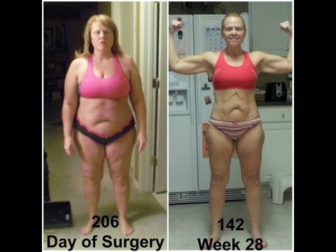 Vertical Sleeve Gastrectomy Before and After Vertical Sleeve Gastrectomy Before and After