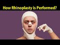 Rhinoplasty  (Nasal surgery) video animation اردو / हिन्दी