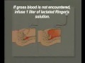 Peritoneum - Intraperitoneal Structures Peritoneum - Intraperitoneal Structures