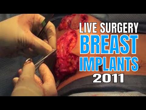 Commit video of breast reduction surgery Share video of breast reduction surgery sorry