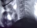DISCOLISIS CERVICAL
