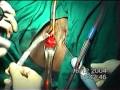 Dr Sanjay Sinha TOT transobturator tape for stress incontinence.mpg