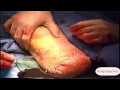 amputacion