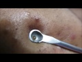 After A Long Time Comedone Extraction images After A Long Time Comedone Extraction